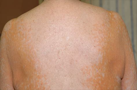 Orange Yellow Diffuse Cutaneous Eruption In An 82 Year Old Woman—quiz