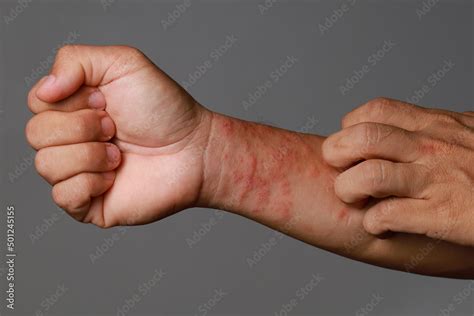 Close Up Allergic Rash Dermatitis Eczema Skin Of Patient Wrist Stock