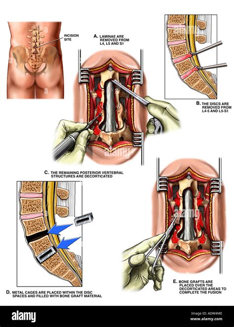 L4 5 Y L5 S1 Laminectomía Y Artrodesis Vertebral Cirugía Fotografía De Stock Alamy