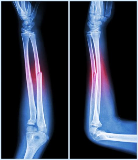 Bone Fracture Whos Vulnerable And How Can You Lower Your Risk