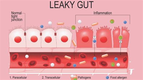 Chronic Illness Toxicity And Leaky Gut Syndrome Dr Shel Wellness