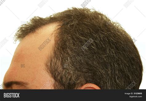 Balding Head Image And Photo Bigstock