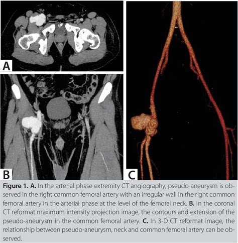 Figure 1 From Femoral Artery Aneurysm Developed On Intimal Sarcoma