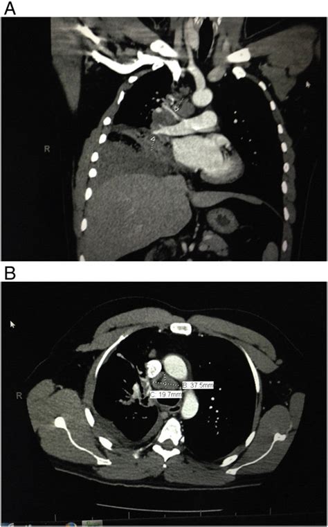 A Coronal Chest Ct Scan Showing The Right Hilar Mass Arrows And