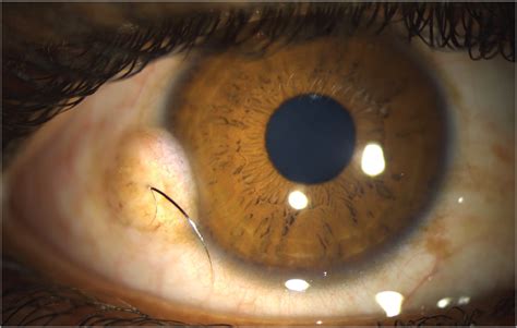 Limbal Dermoid In A Teenage Boy Adolescent Medicine Jama