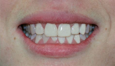 dental porcelain and teeth veneers sydney a better smile dental centre