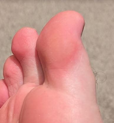 Callus On Foot Removal