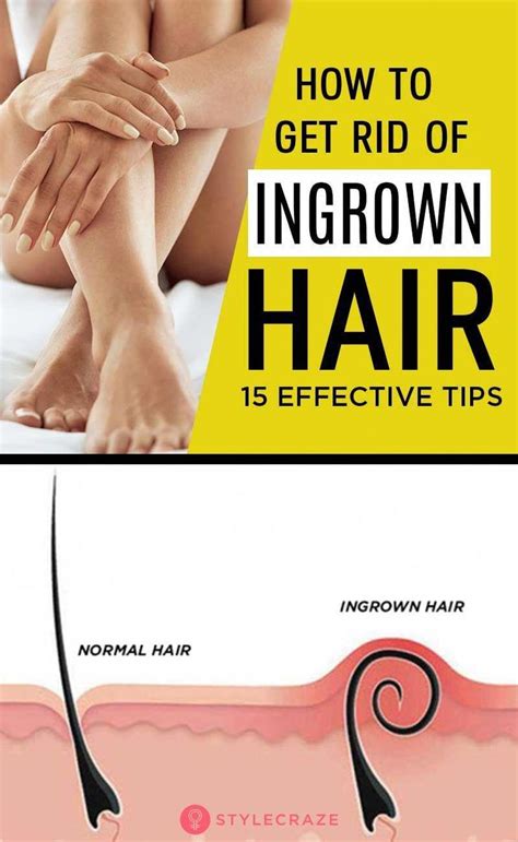 15 Simple Tips To Reduce The Growth Of Ingrown Hair Haircare Tips