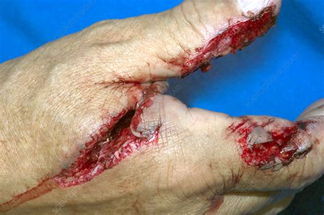 Hand Laceration - Stock Image - M330/1264 - Science Photo Library