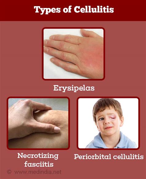 Cellulitis Causes Symptoms Diagnosis Treatment How To Avoid