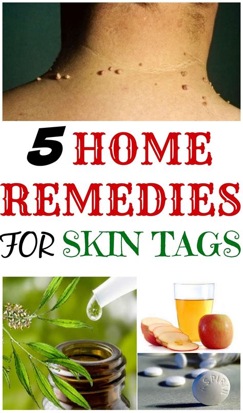 List Of 8 Home Remedies To Remove Skin Tags Trend In 2022 Best Home