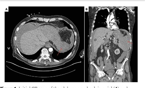 Figure 1 From Spontaneous Splenic Rupture From Indeterminate Dendritic