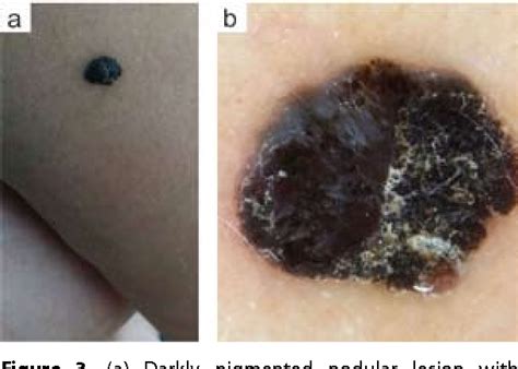Dermoscopy Of Nodular Melanoma Review Of The Literature And Report Of
