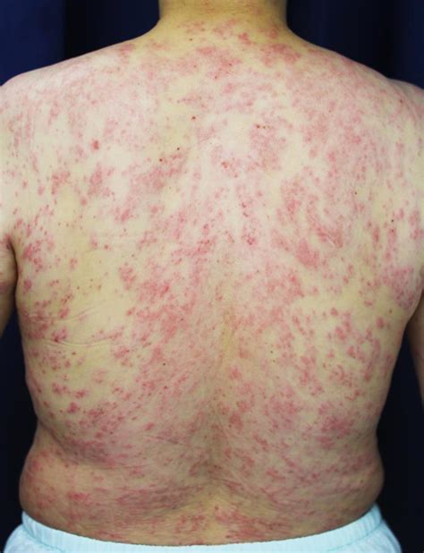 Rash After Consumption Of Game Meat The Bmj