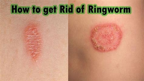 Home Remedies For Ringworm Everyone Should Know