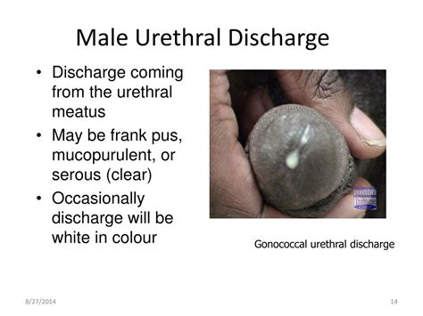 viral urethritis men