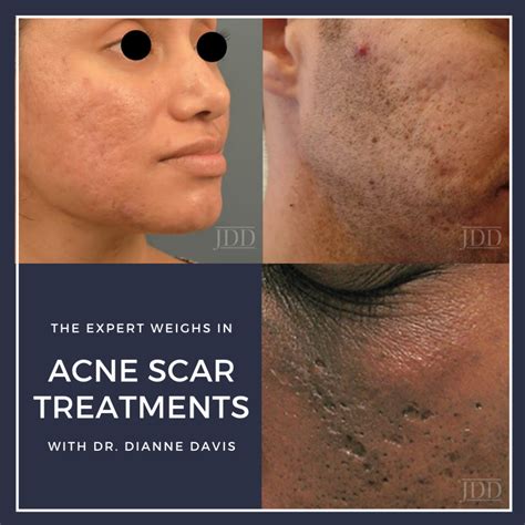 Acne Scar Treatments The Expert Weighs In Next Steps In Dermatology