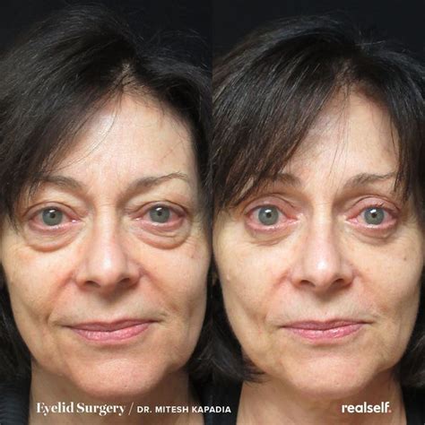 Under Eye Bags Eye Bags Skin Fillers Face Treatment