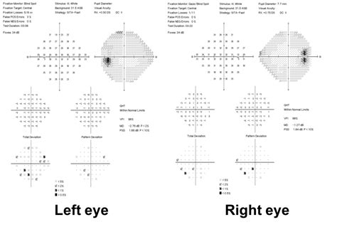 Neurological Visual Field Defect