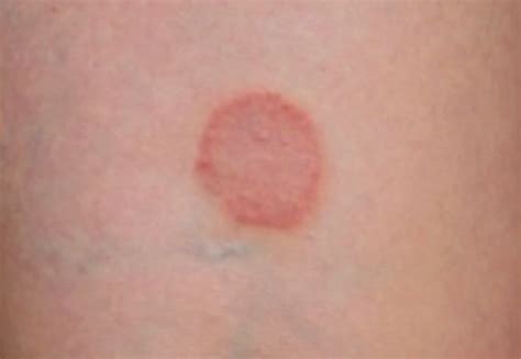 Ringworm Images Causes Symptoms Treatment Hubpages