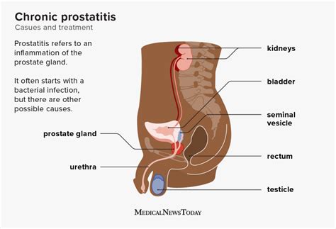 Chronic Prostatitis Causes Symptoms Diagnosis And Treatment