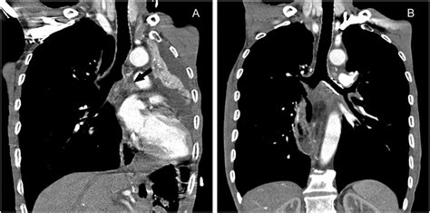 An Esophageal Cancer Patient Complicated By Mediastinal Lymph Node
