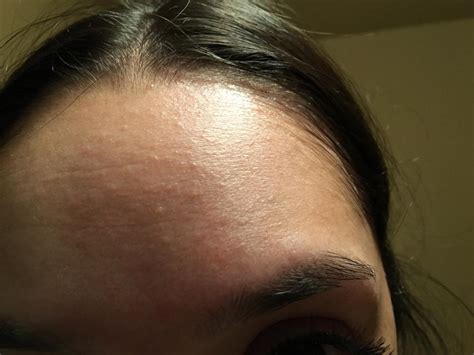 Small Forehead Bumps That Won T Go Away General Acne Discussion