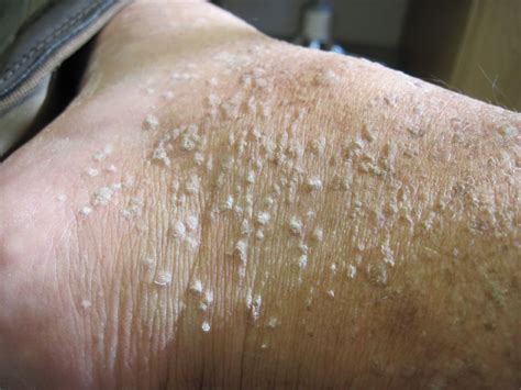 Stucco Keratosis On Right Ankle On Curezone Image Gallery