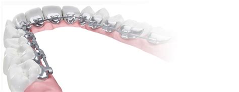 Lingual Braces Embrace U Orthodontics