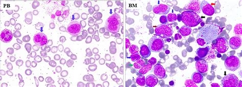 P210bcr‐abl1‐ Chronic Myeloid Leukemia Presents With Monocytosis Wang