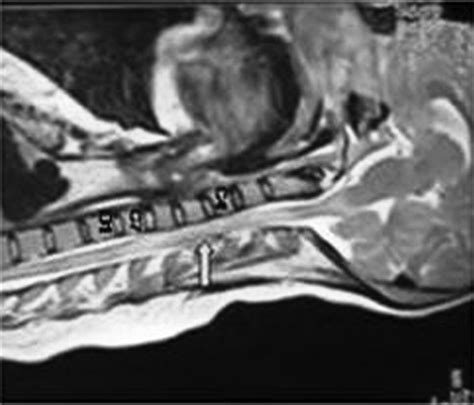 Spontaneous Spinal Epidural Haematoma A Rare Cause Of Quadriplegia In