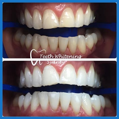 Teeth Whitening Transformation Dentagama