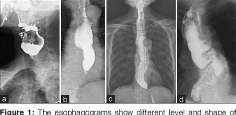 Figure 1 From Surgical Treatment Of Noncaustic Benign Esophageal