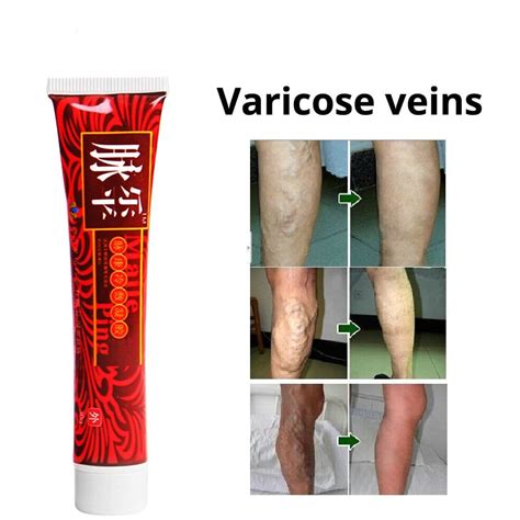 Varicose Veins Miracle Cream ⋆ Cozexs Varicose Veins Miracle Cream