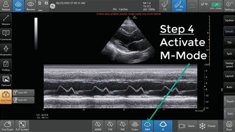 Ultrasound M Mode Step By Step Guide E Point Septal Separation Epss