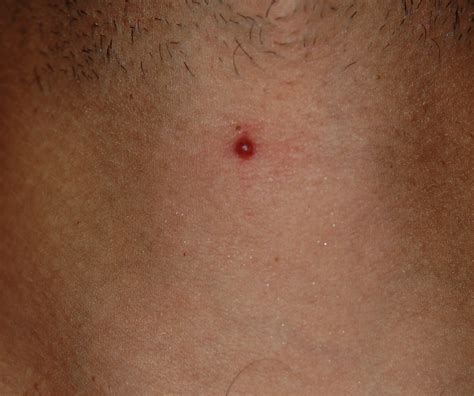 I Have A Small Red Painless Pimple On Neck Near Adams Apple