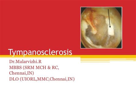 Tympanosclerosis