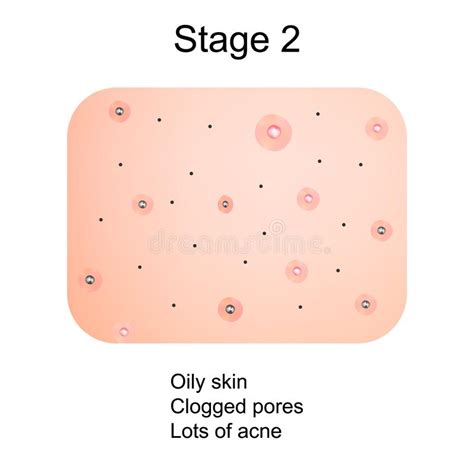 Fase 2 Do Desenvolvimento Da Acne Pele Inflamada Com Cicatrizes Acne E