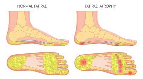 Fat Pad Atrophy What Is Fat Pad Atrophy How To Treat Fat Pad Atrophy