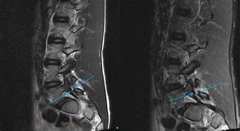 Mri Assessment Of The Spine To Assess For The Presence Ofspondylolysis