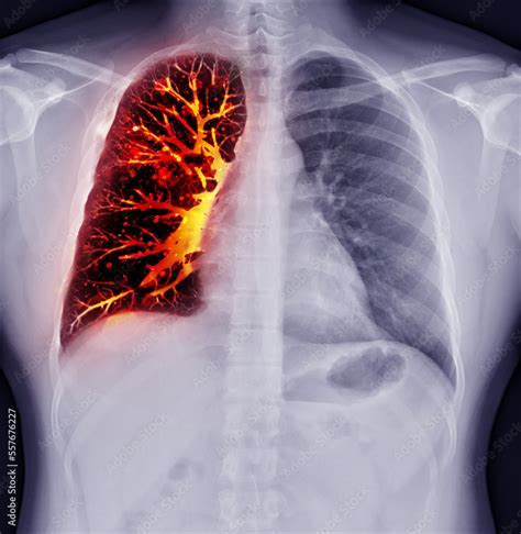 Fusion Image Of Chest X Ray And Ct Chest Coronal View For Lung