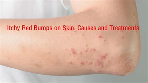 Itchy Red Bumps On Skin Hqrw
