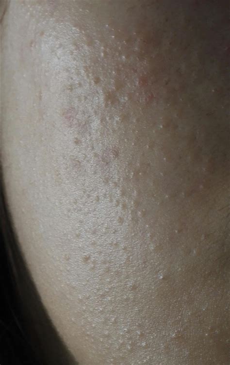Skin Concerns Tiny Bumps All Over My Face Skincareaddiction