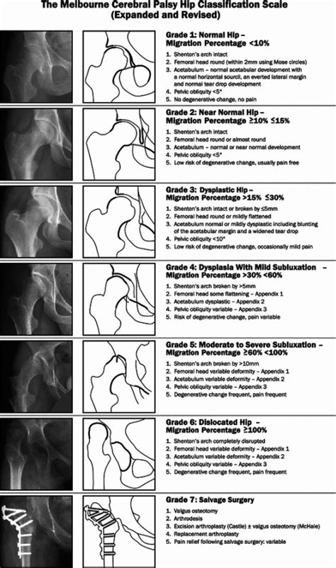 The Melbourne Cerebral Palsy Hip Classification Scale Open I