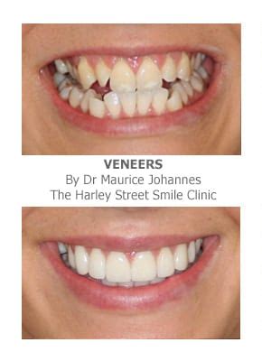 If your teeth are crooked and it bothers you, now is a good time to do something about this! Veneers for Crooked Teeth | Harley Street Smile Clinic