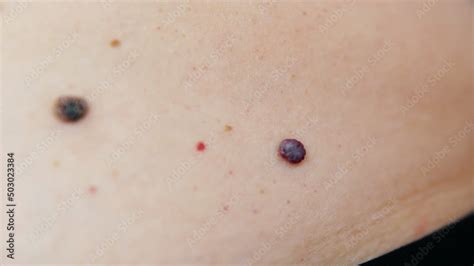 Obraz Red Moles And Dots On The Female Body Large Mole On Stomach