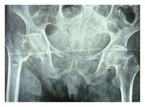 Greater Trochanteric Fixation Using A Cable System For Partial Hip