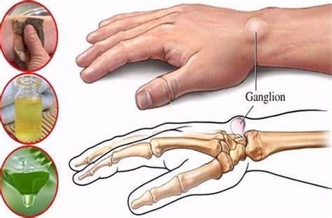 The Best 3 Home Remedies To Get Rid Of Ganglion Cysts Mindwaft
