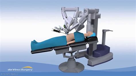 Da Vinci Single Site Cholecystectomy Gallbladder Surgery Youtube