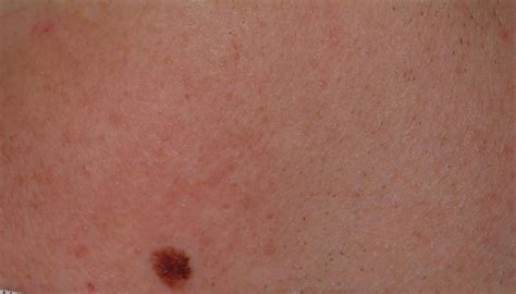 Skin Cancer Apps Can Be Dangerously Wrong Huffpost Life